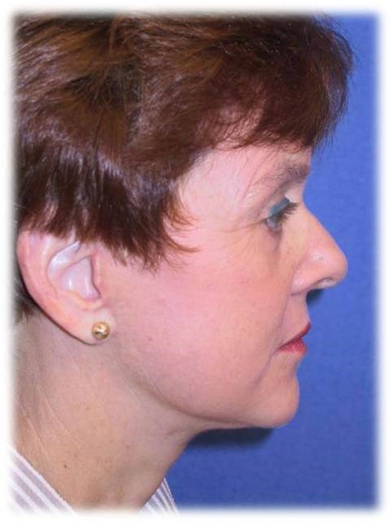 Dr. Cayce Rumsey Before & After Gallery - Patient 89865298 - Image 2