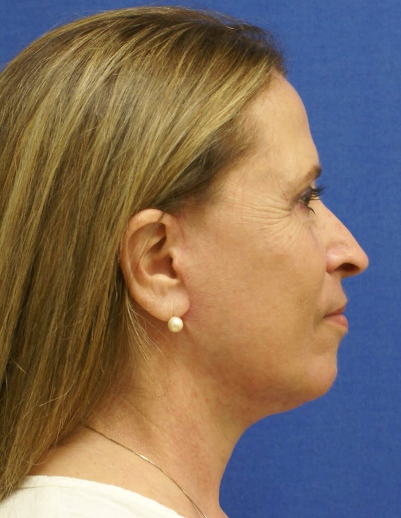 Dr. Cayce Rumsey Before & After Gallery - Patient 89865324 - Image 2
