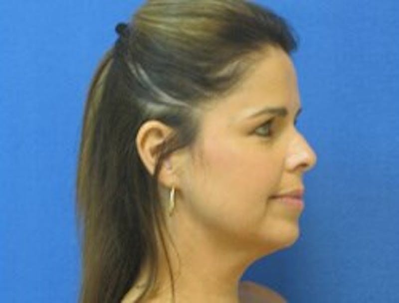 Dr. Cayce Rumsey Before & After Gallery - Patient 89882787 - Image 3