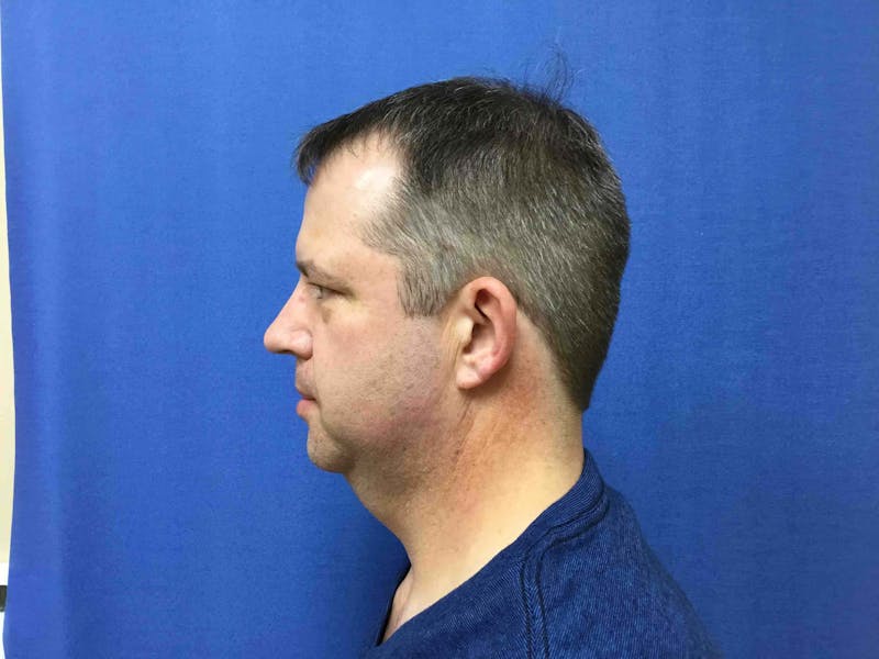 Dr. Cayce Rumsey Before & After Gallery - Patient 89885592 - Image 3
