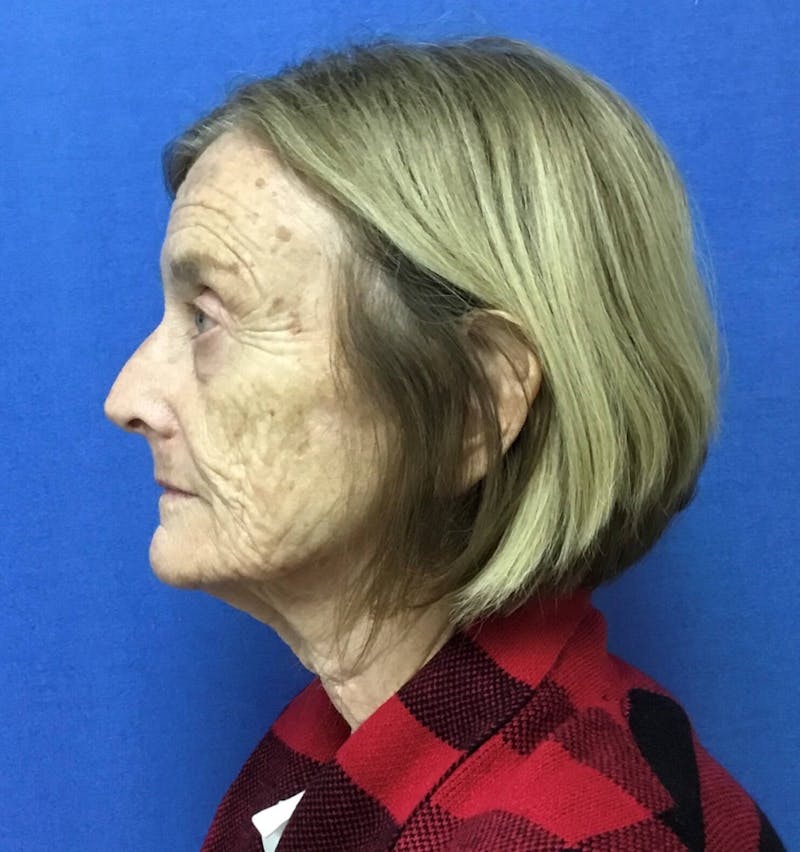 Dr. Cayce Rumsey Before & After Gallery - Patient 89893951 - Image 9