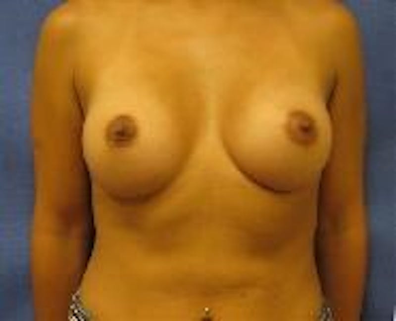 Dr. Cayce Rumsey Before & After Gallery - Patient 89898565 - Image 2