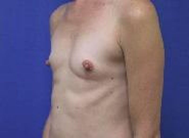 Dr. Cayce Rumsey Before & After Gallery - Patient 89898628 - Image 3
