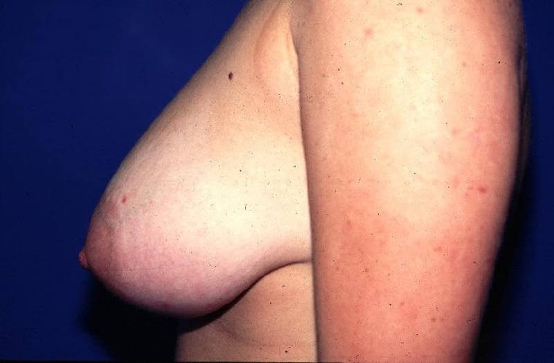 Dr. Cayce Rumsey Before & After Gallery - Patient 89911242 - Image 3