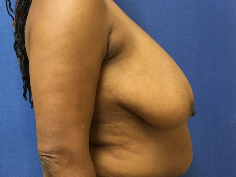 Dr. Cayce Rumsey Before & After Gallery - Patient 89912106 - Image 3