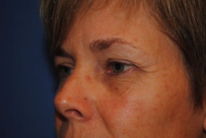 Dr. Robert Burk Before & After Gallery - Patient 89912376 - Image 3