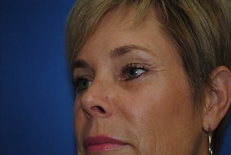 Dr. Robert Burk Before & After Gallery - Patient 89912376 - Image 4