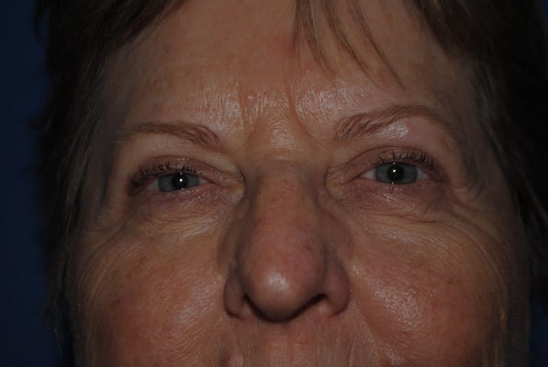 Dr. Robert Burk Before & After Gallery - Patient 89912381 - Image 2