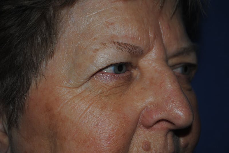 Dr. Robert Burk Before & After Gallery - Patient 89912381 - Image 3