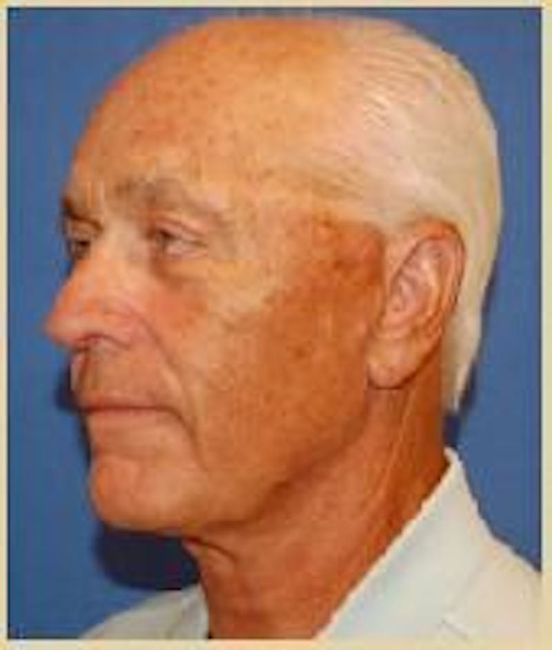 Dr. Robert Burk Before & After Gallery - Patient 89912398 - Image 4