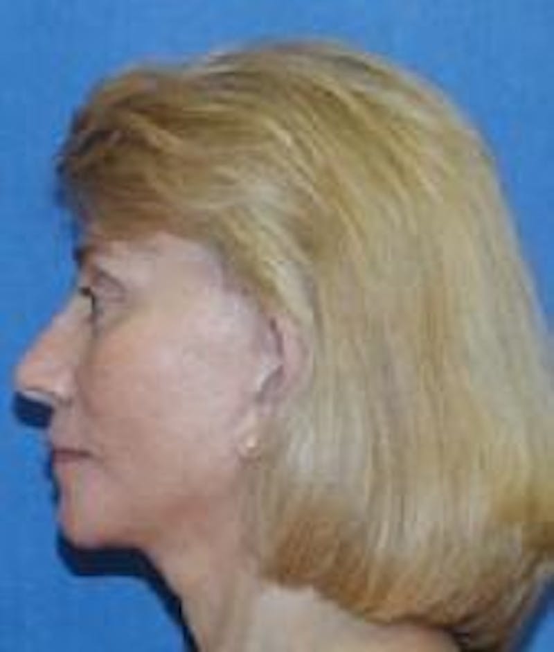 Dr. Robert Burk Before & After Gallery - Patient 89912407 - Image 2