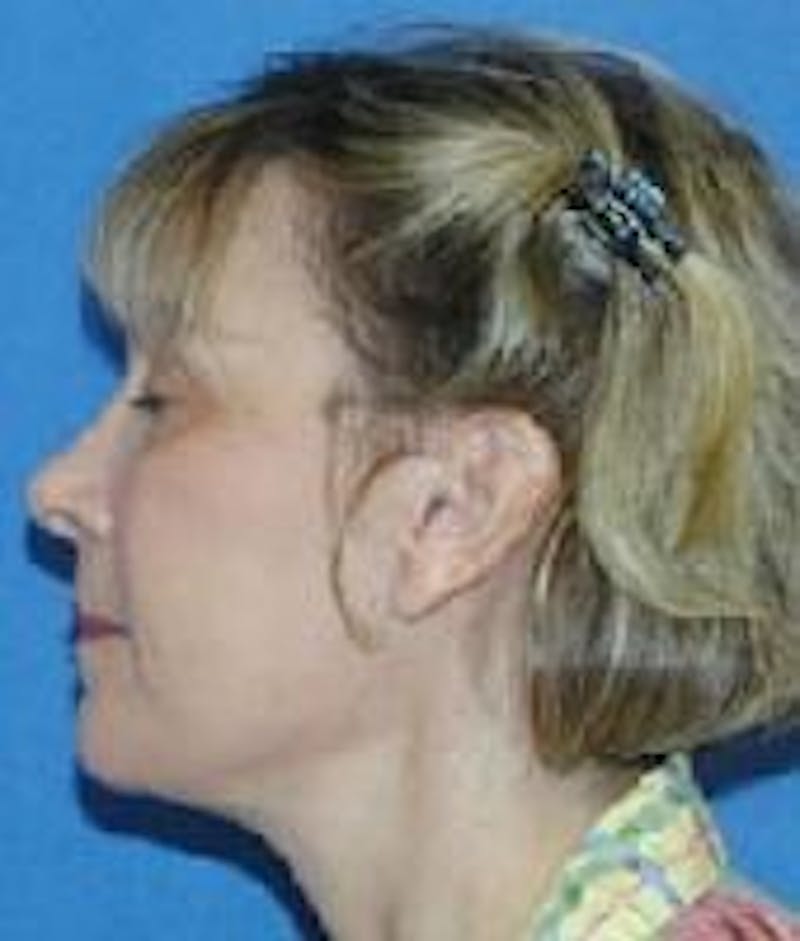 Dr. Robert Burk Before & After Gallery - Patient 89926831 - Image 2