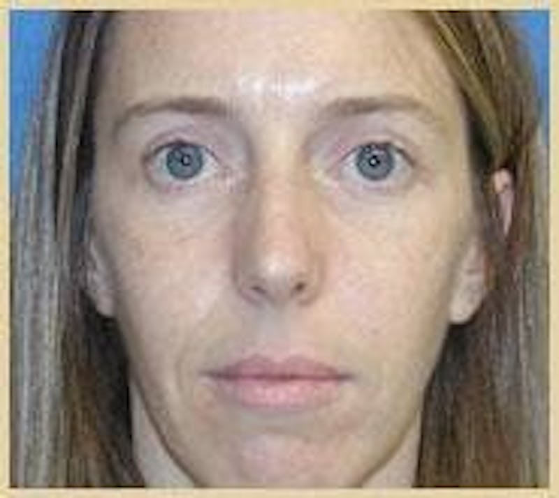 Dr. Robert Burk Before & After Gallery - Patient 89928024 - Image 3