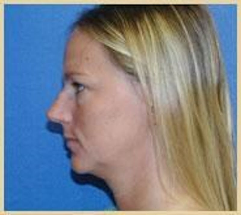 Dr. Robert Burk Before & After Gallery - Patient 89928318 - Image 1