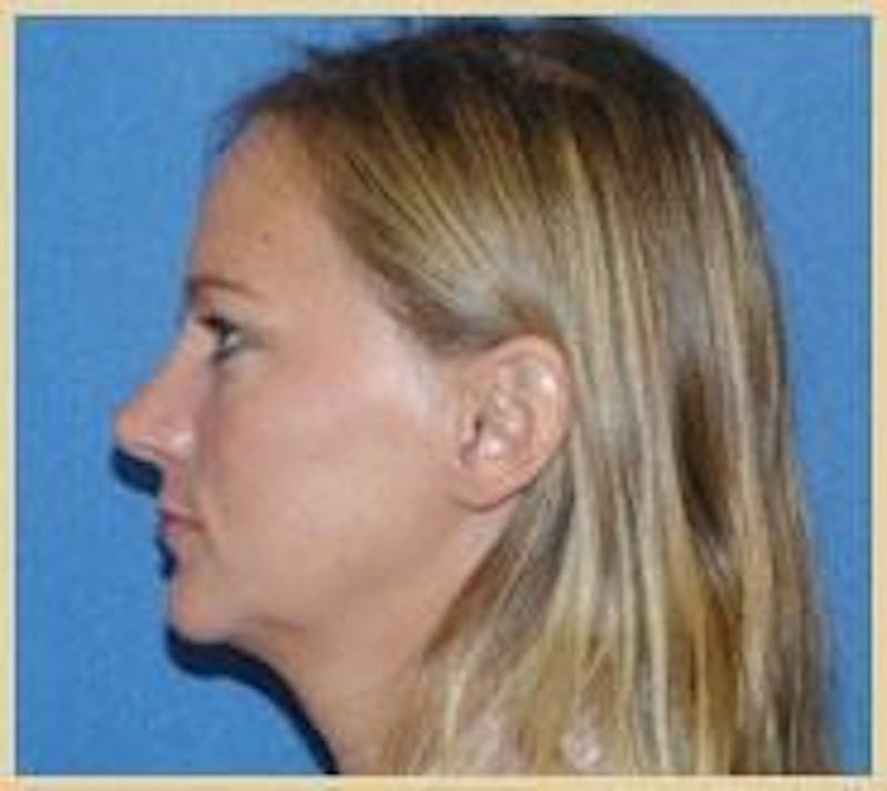 Dr. Robert Burk Before & After Gallery - Patient 89928318 - Image 2