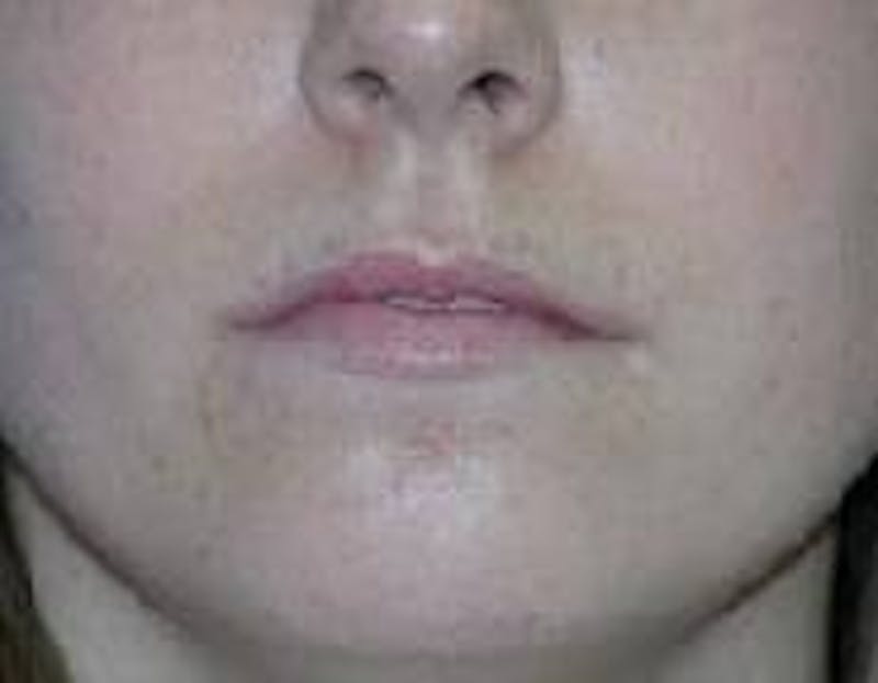 Dr. Robert Burk Before & After Gallery - Patient 89928347 - Image 3