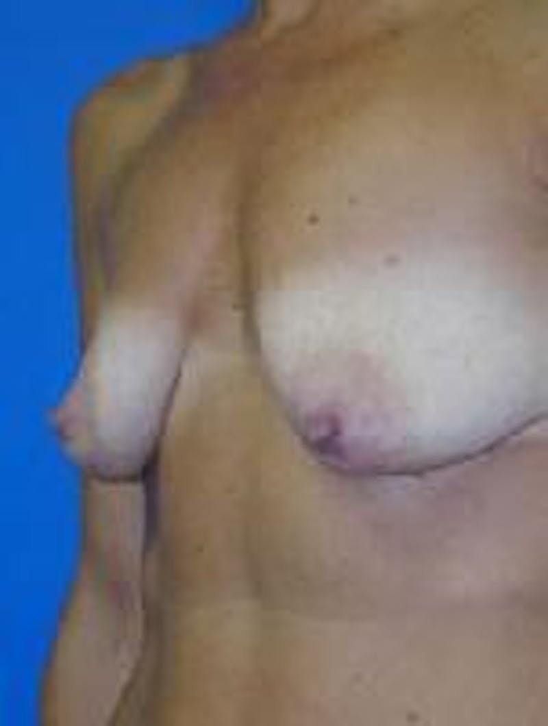 Dr. Robert Burk Before & After Gallery - Patient 89929574 - Image 3