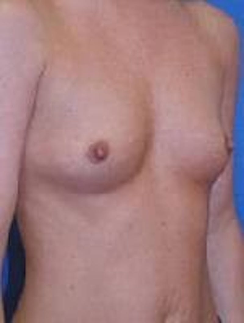 Dr. Robert Burk Before & After Gallery - Patient 89929576 - Image 3