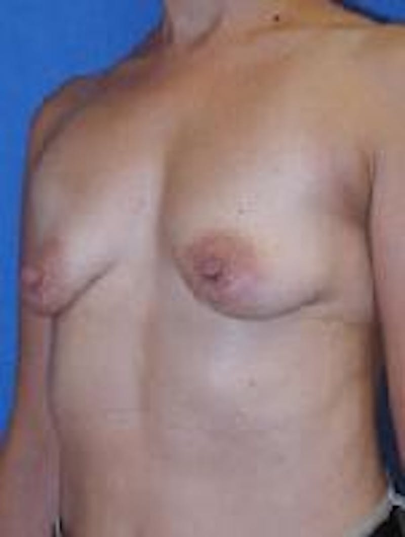 Dr. Robert Burk Before & After Gallery - Patient 89929578 - Image 3