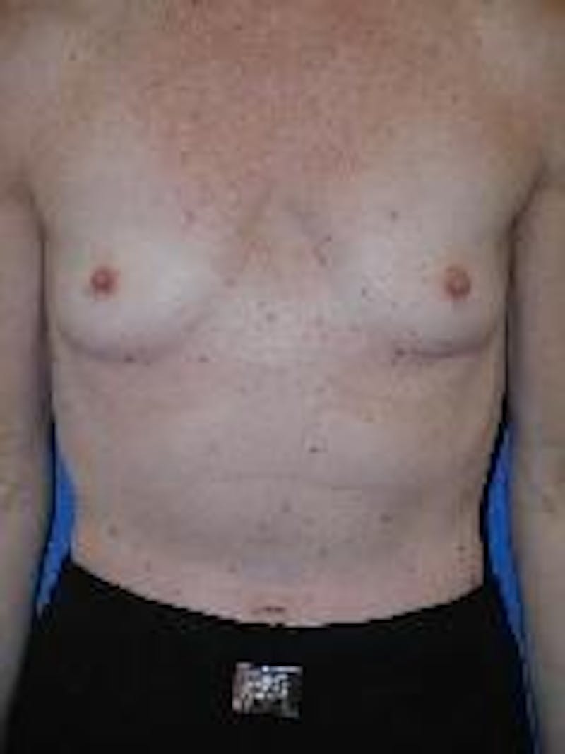 Dr. Robert Burk Before & After Gallery - Patient 89930072 - Image 1