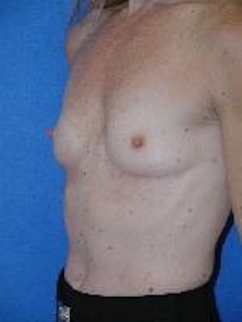 Dr. Robert Burk Before & After Gallery - Patient 89930072 - Image 3
