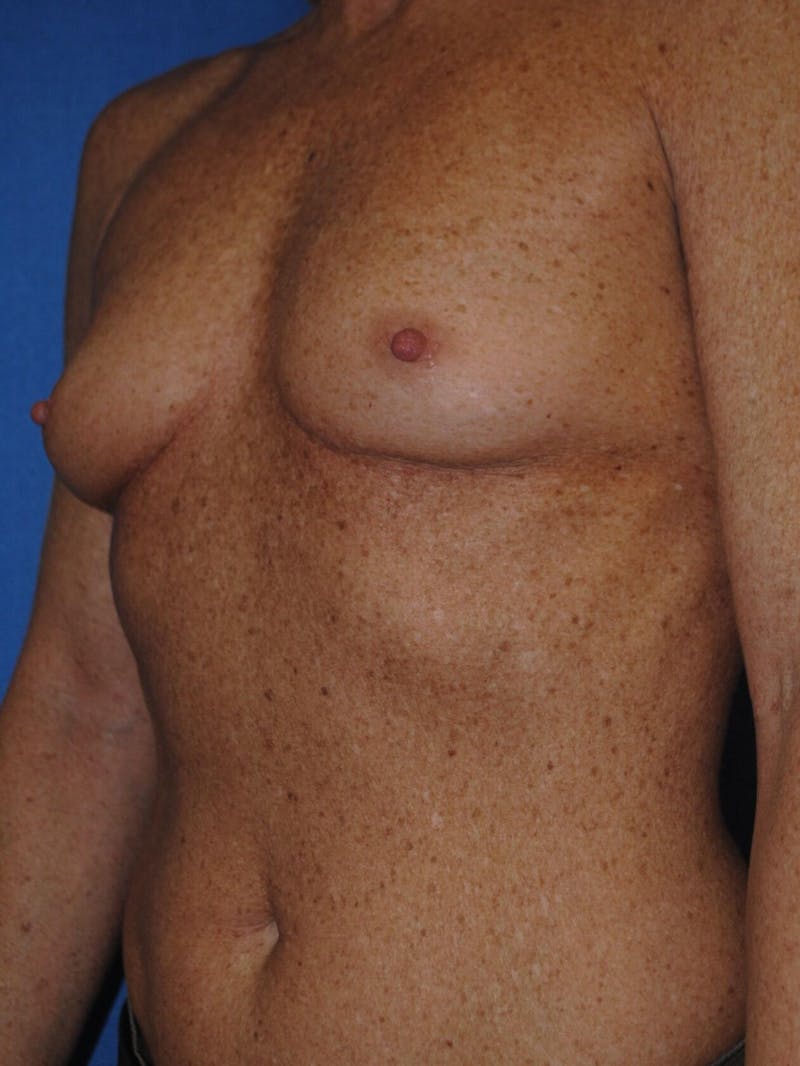 Dr. Robert Burk Before & After Gallery - Patient 89930422 - Image 3