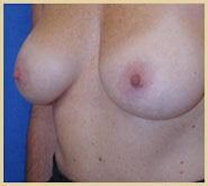 Dr. Robert Burk Before & After Gallery - Patient 89931818 - Image 3