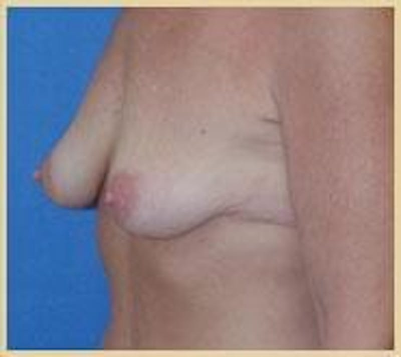 Dr. Robert Burk Before & After Gallery - Patient 89931938 - Image 3