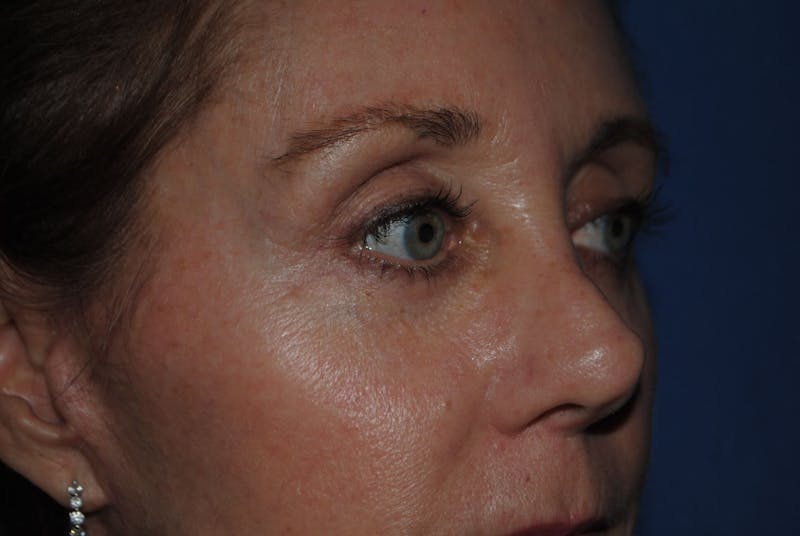 Dr. Robert Burk Before & After Gallery - Patient 89932201 - Image 8