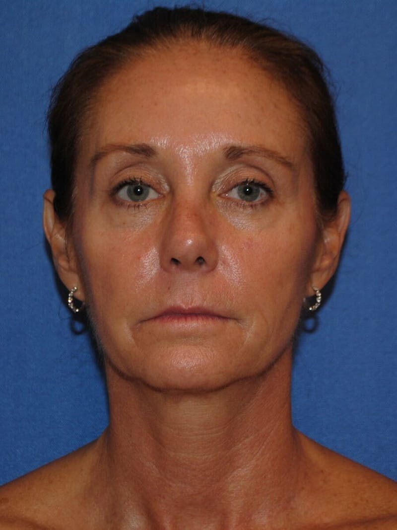 Dr. Robert Burk Before & After Gallery - Patient 89932201 - Image 9
