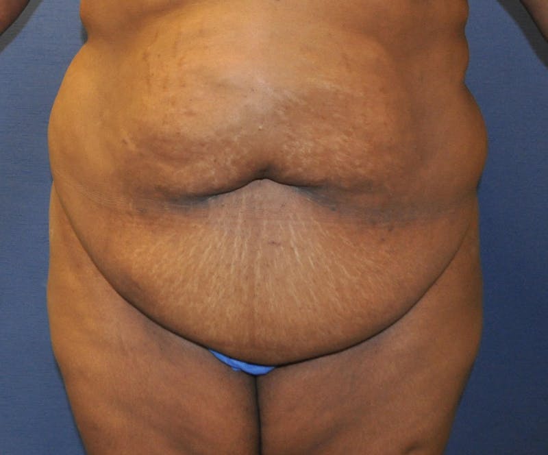 Dr. Erez Sternberg Before & After Gallery - Patient 89932577 - Image 1