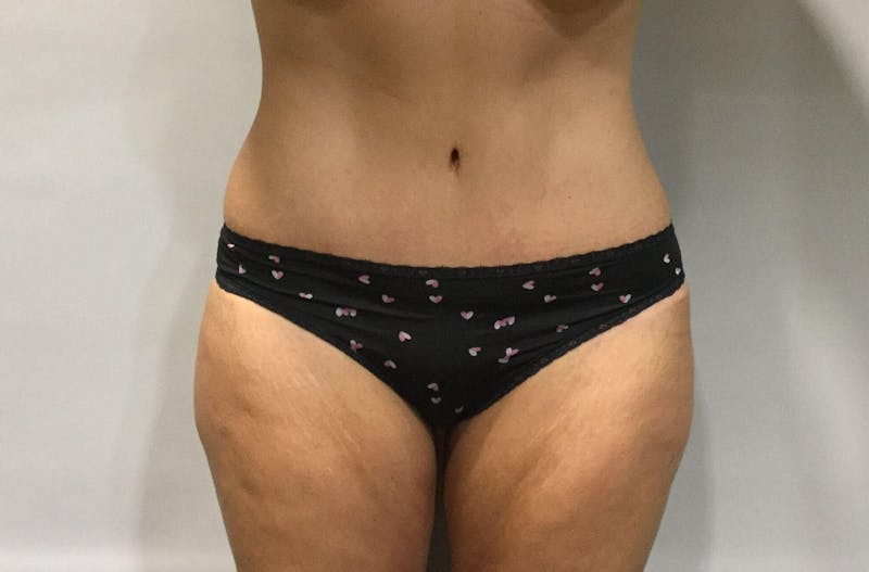 Dr. Erez Sternberg Before & After Gallery - Patient 89932586 - Image 2