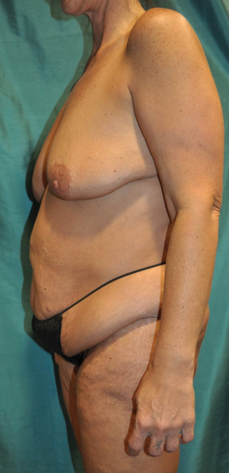 Dr. Erez Sternberg Before & After Gallery - Patient 89932700 - Image 3