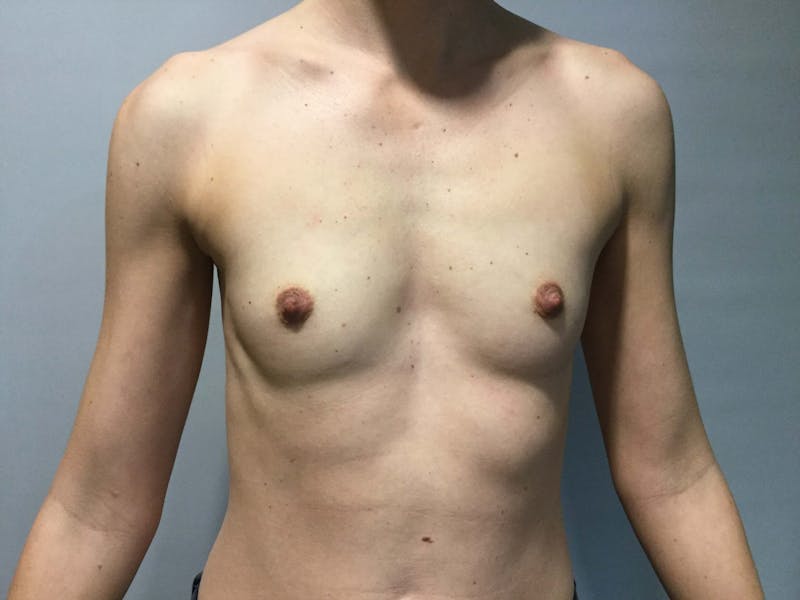 Dr. Erez Sternberg Before & After Gallery - Patient 89936507 - Image 1