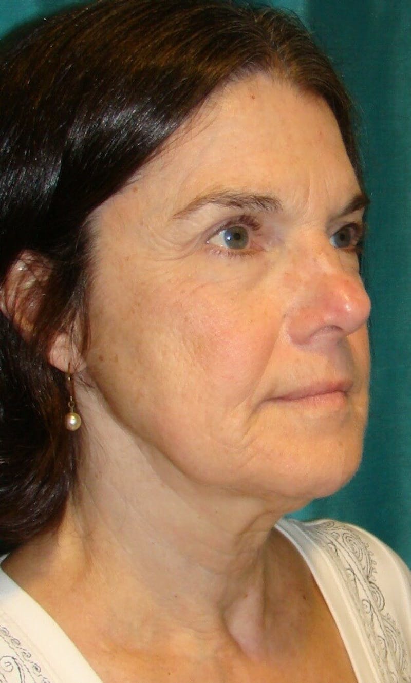 Dr. Hollie Hickman Before & After Gallery - Patient 89943089 - Image 3