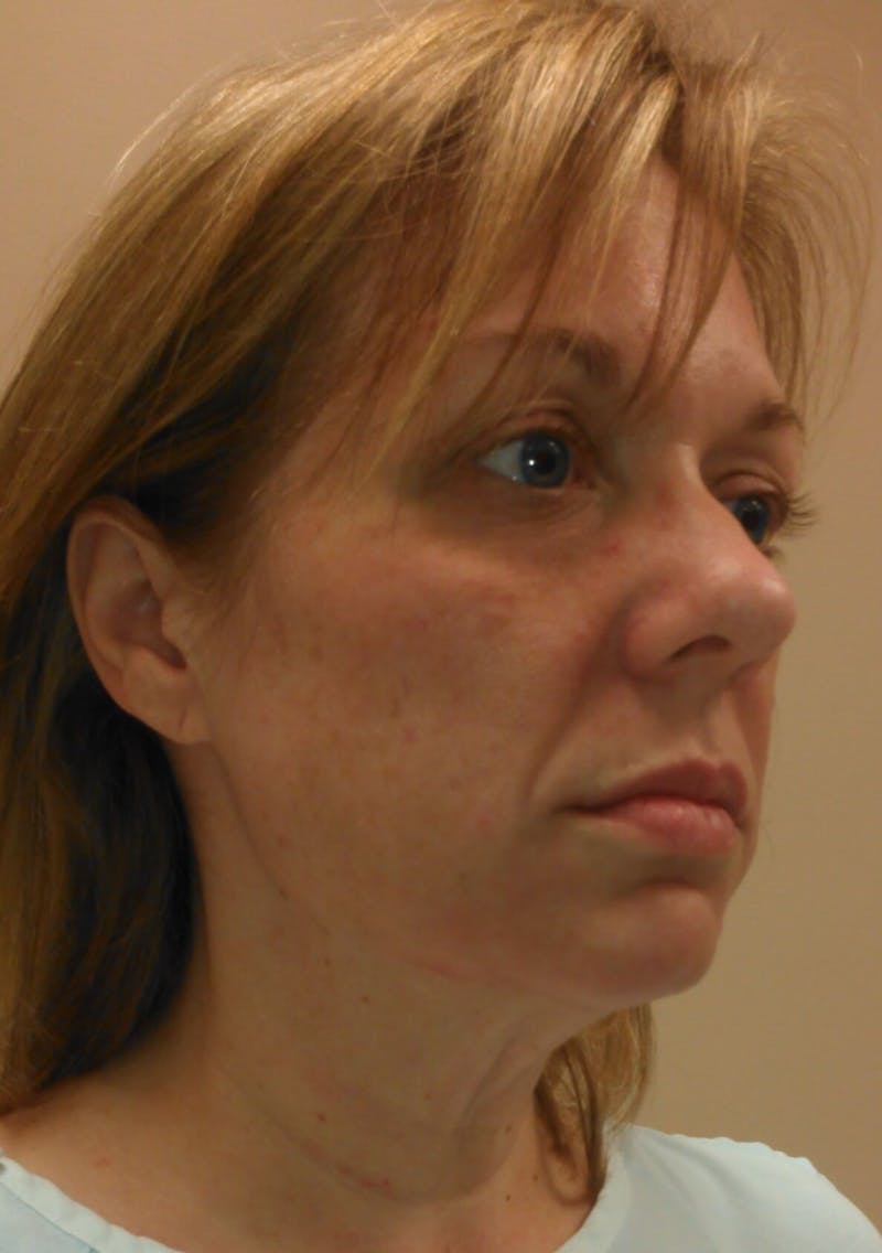 Dr. Hollie Hickman Before & After Gallery - Patient 89943090 - Image 5