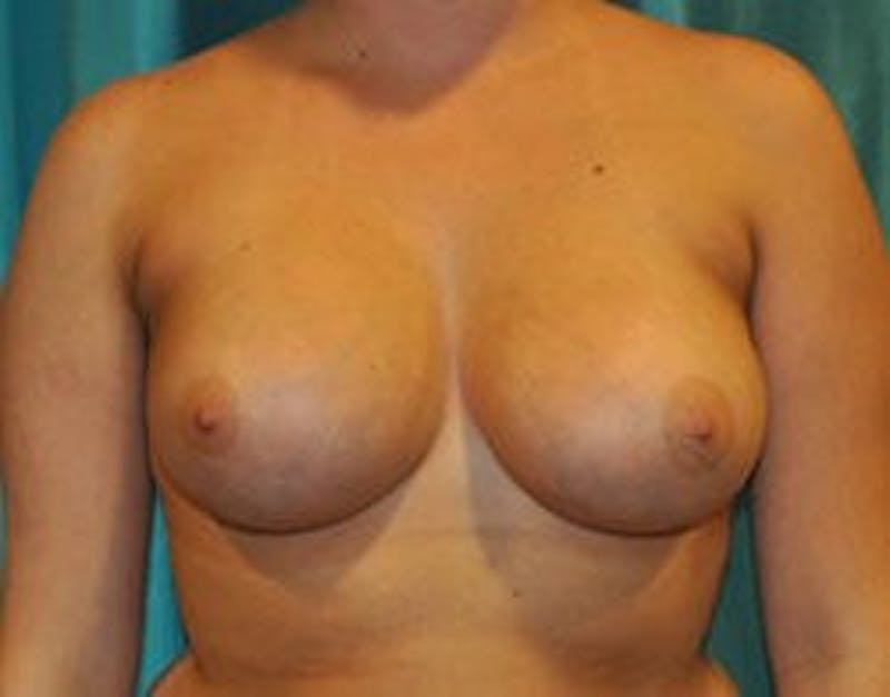 Dr. Hollie Hickman Before & After Gallery - Patient 89969002 - Image 2