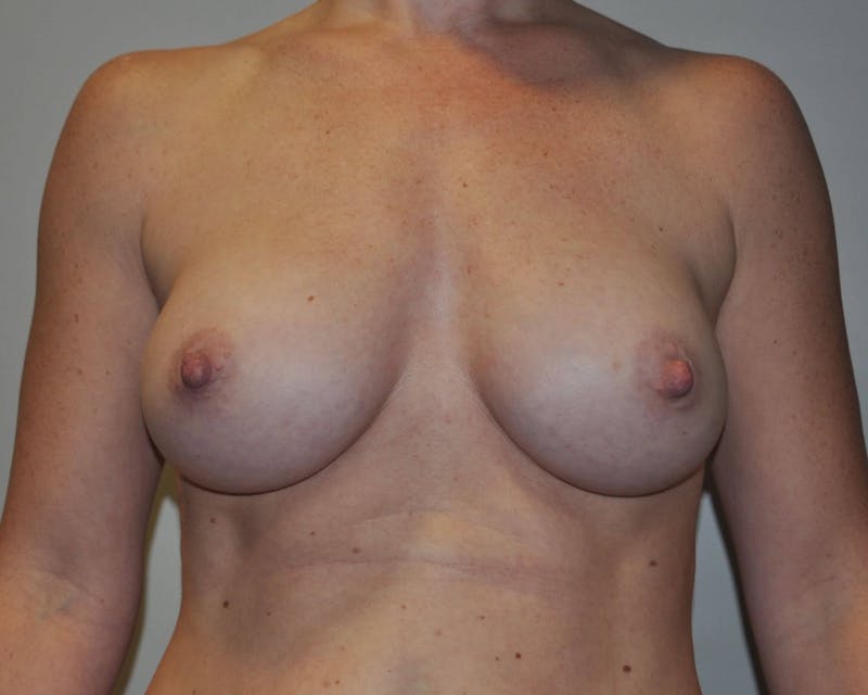 Dr. Hollie Hickman Before & After Gallery - Patient 89969587 - Image 2