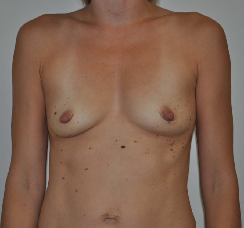 Dr. Hollie Hickman Before & After Gallery - Patient 89969844 - Image 1