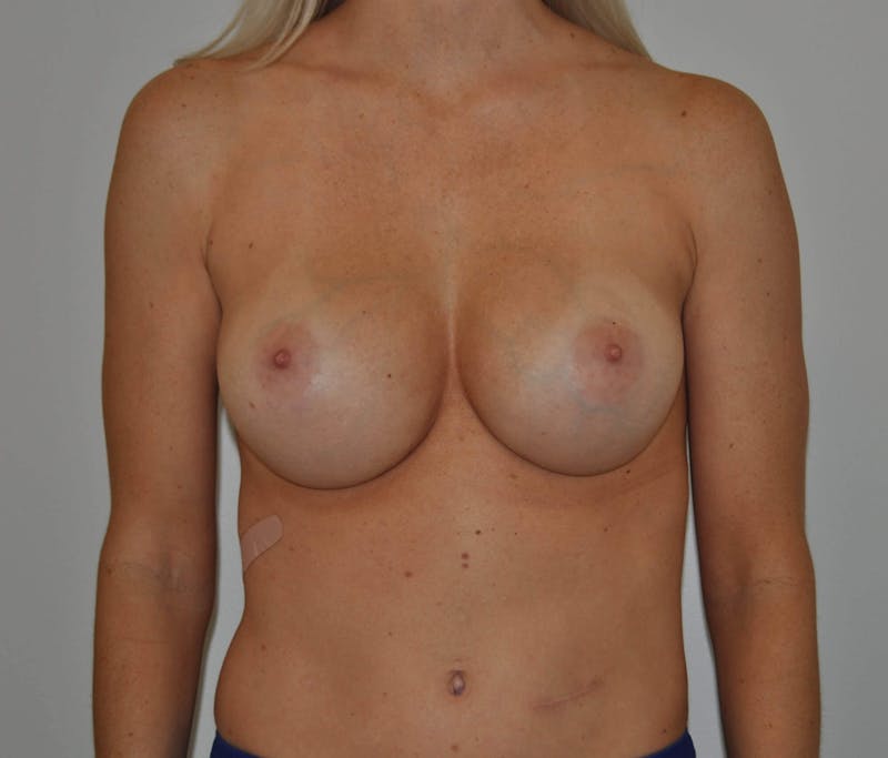 Dr. Hollie Hickman Before & After Gallery - Patient 89970142 - Image 2