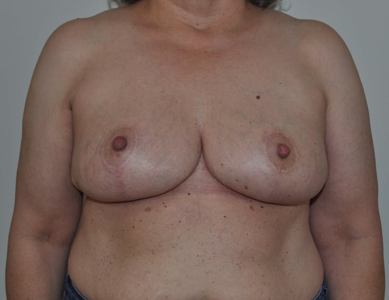 Dr. Hollie Hickman Before & After Gallery - Patient 89970648 - Image 2