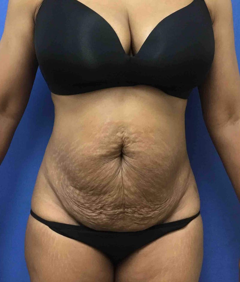 Tummy Tuck Before & After Gallery - Patient 89987810 - Image 1