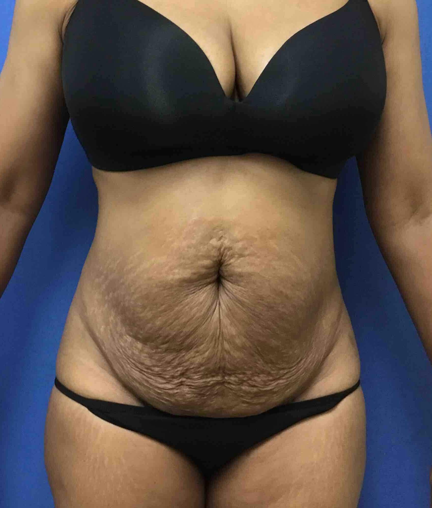 Tummy Tuck Gallery - Patient 89987810 - Image 1