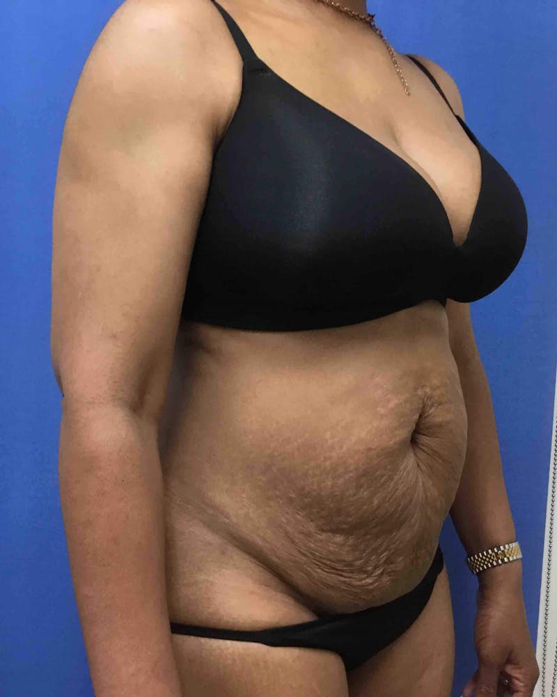 Tummy Tuck Before & After Gallery - Patient 89987810 - Image 5