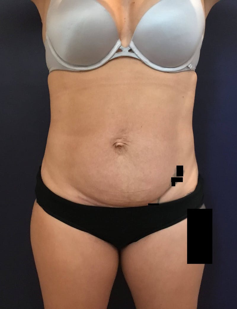 Tummy Tuck Before & After Gallery - Patient 89987811 - Image 1