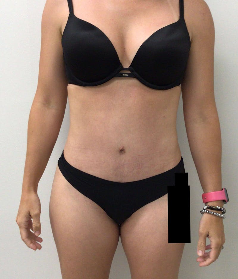 Tummy Tuck Before & After Gallery - Patient 89987811 - Image 2
