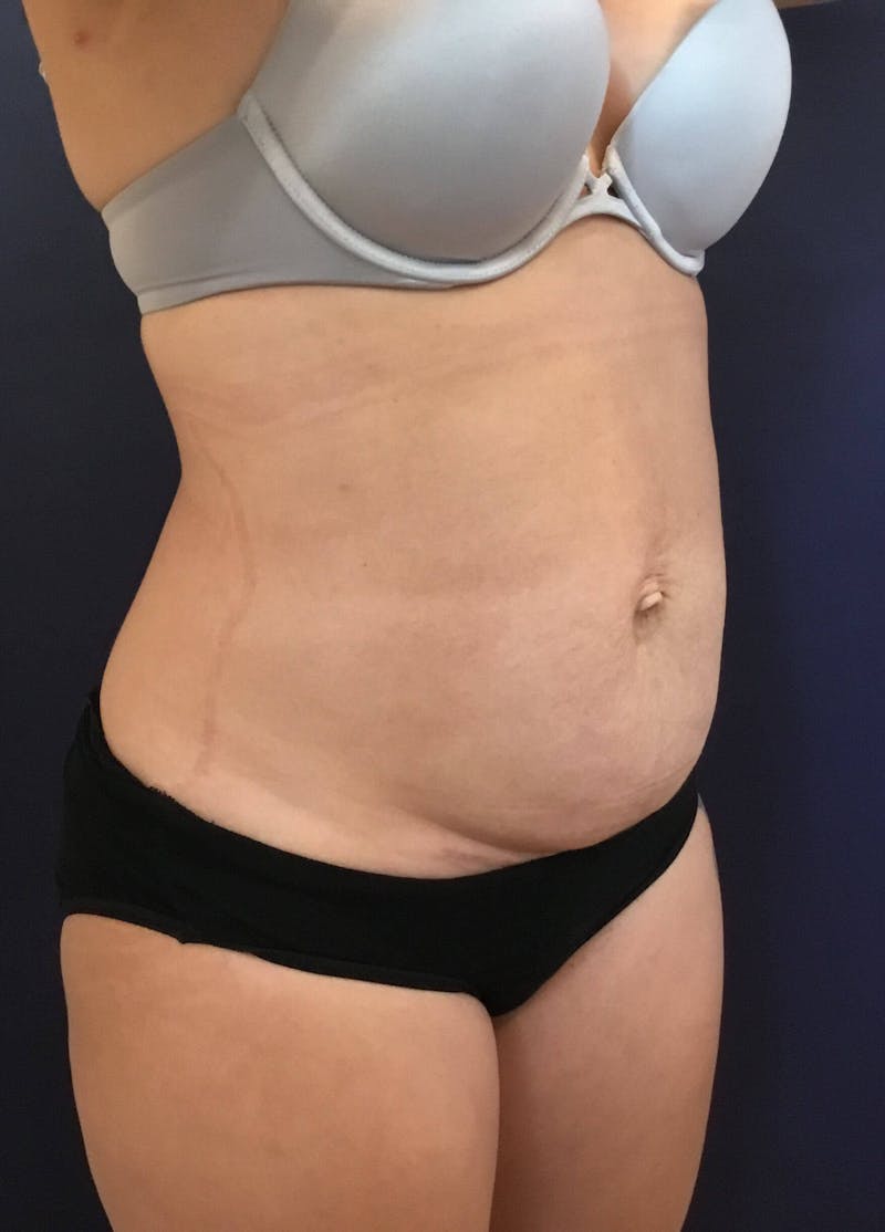 Tummy Tuck Before & After Gallery - Patient 89987811 - Image 3