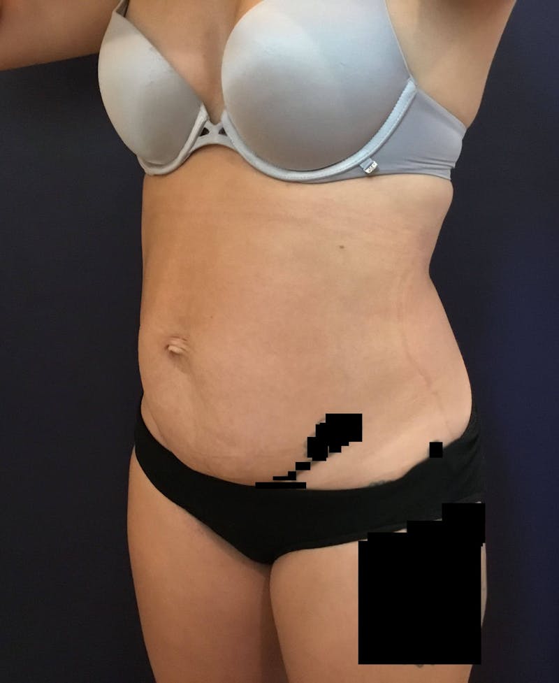 Tummy Tuck Before & After Gallery - Patient 89987811 - Image 5