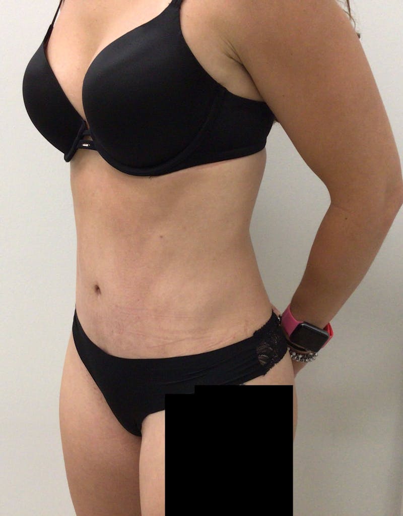 Tummy Tuck Before & After Gallery - Patient 89987811 - Image 6