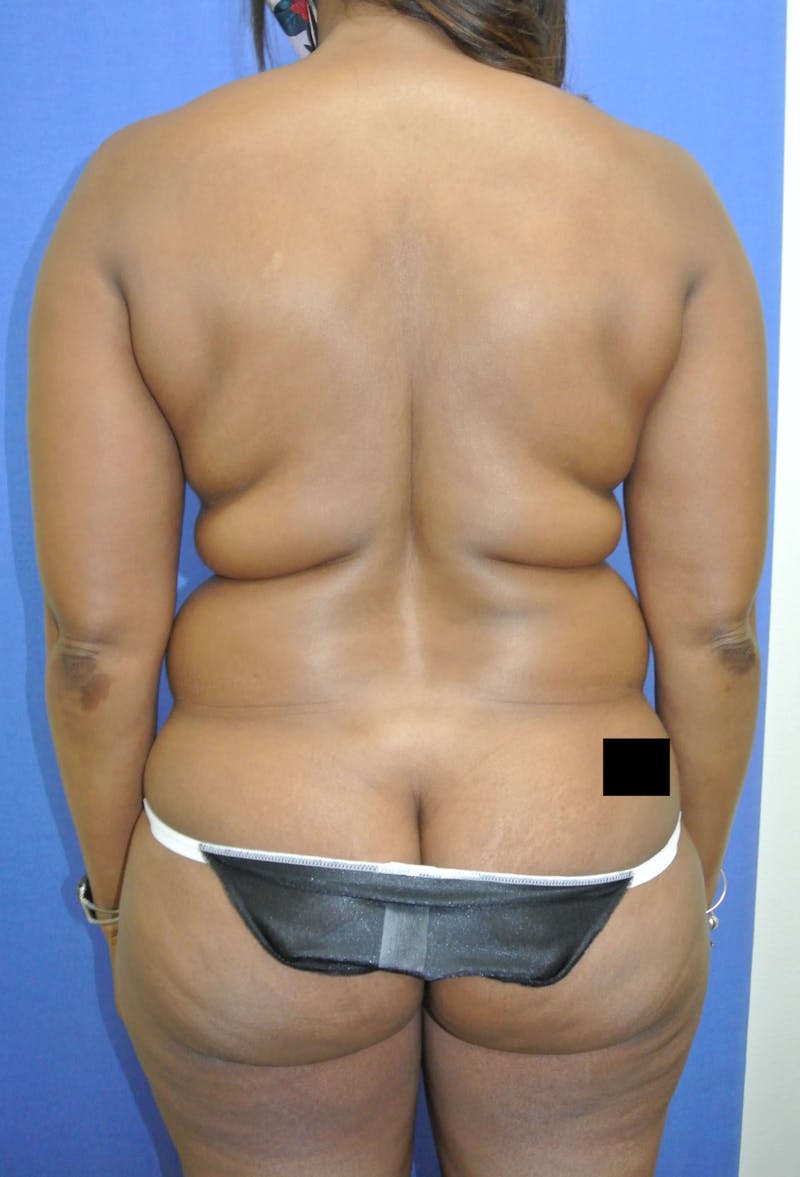 Tummy Tuck Before & After Gallery - Patient 89987833 - Image 3